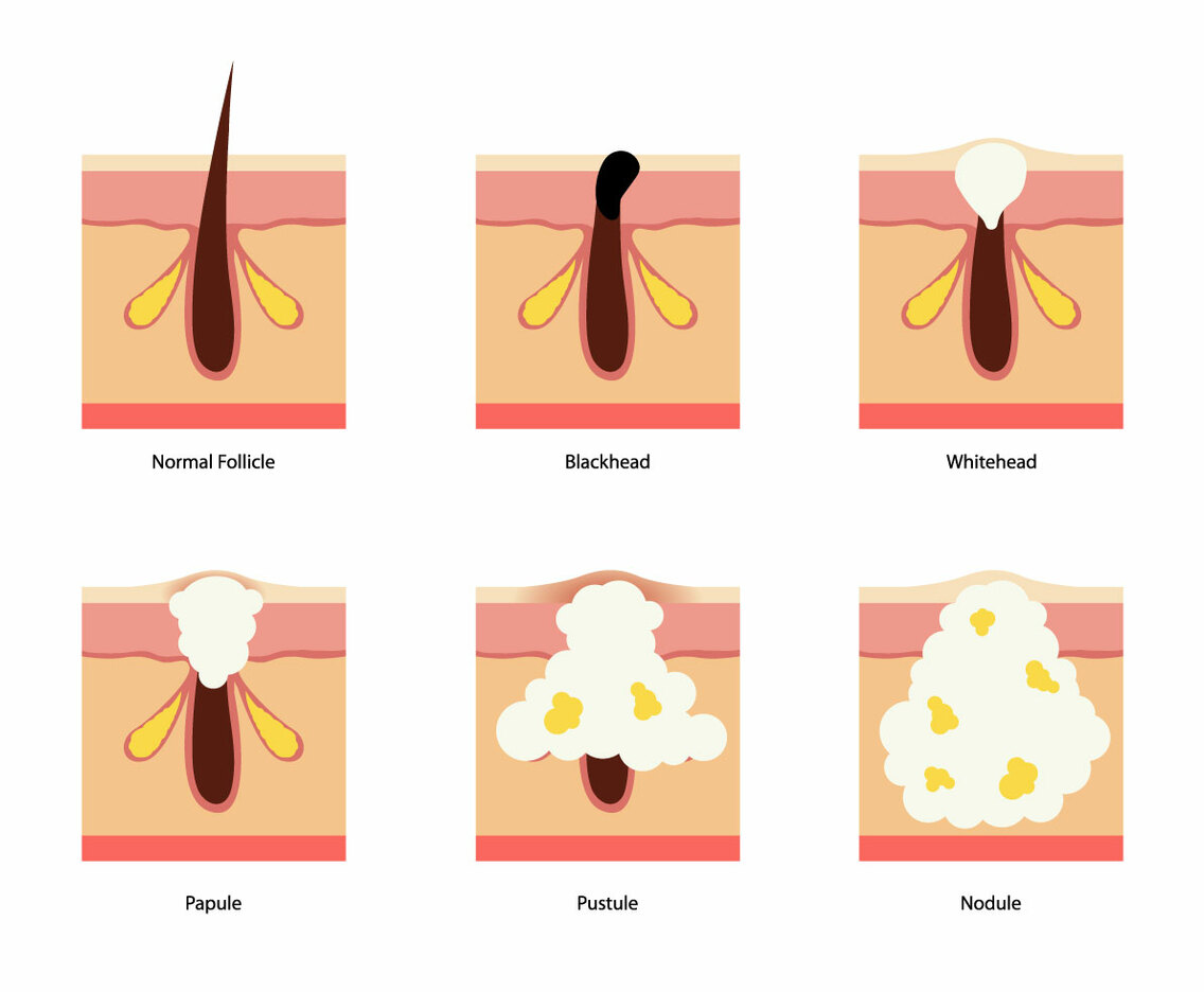 Pimple Vector