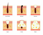 Pimple Vector