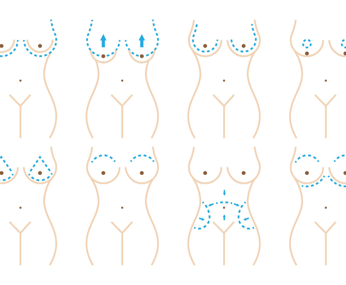 Breast Surgery