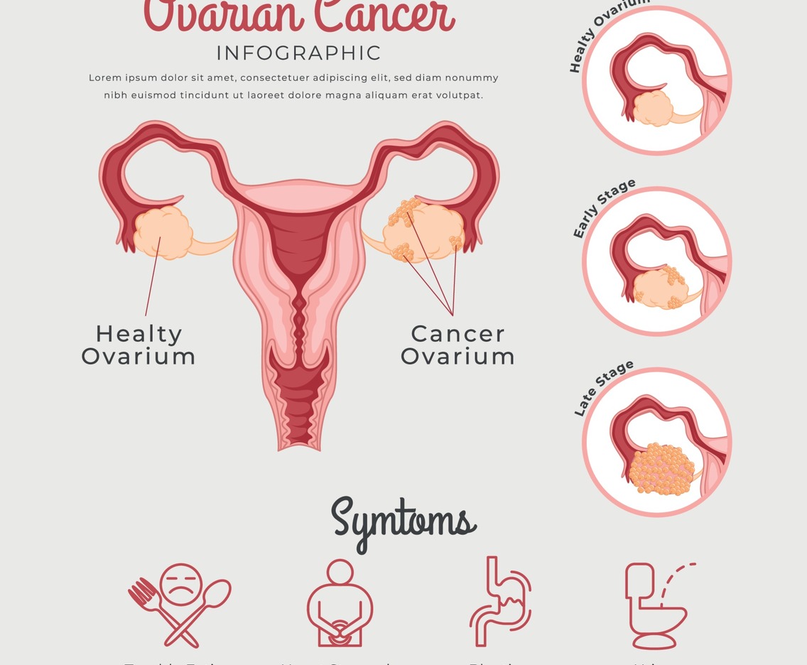 Ovarian Cancer Infographic