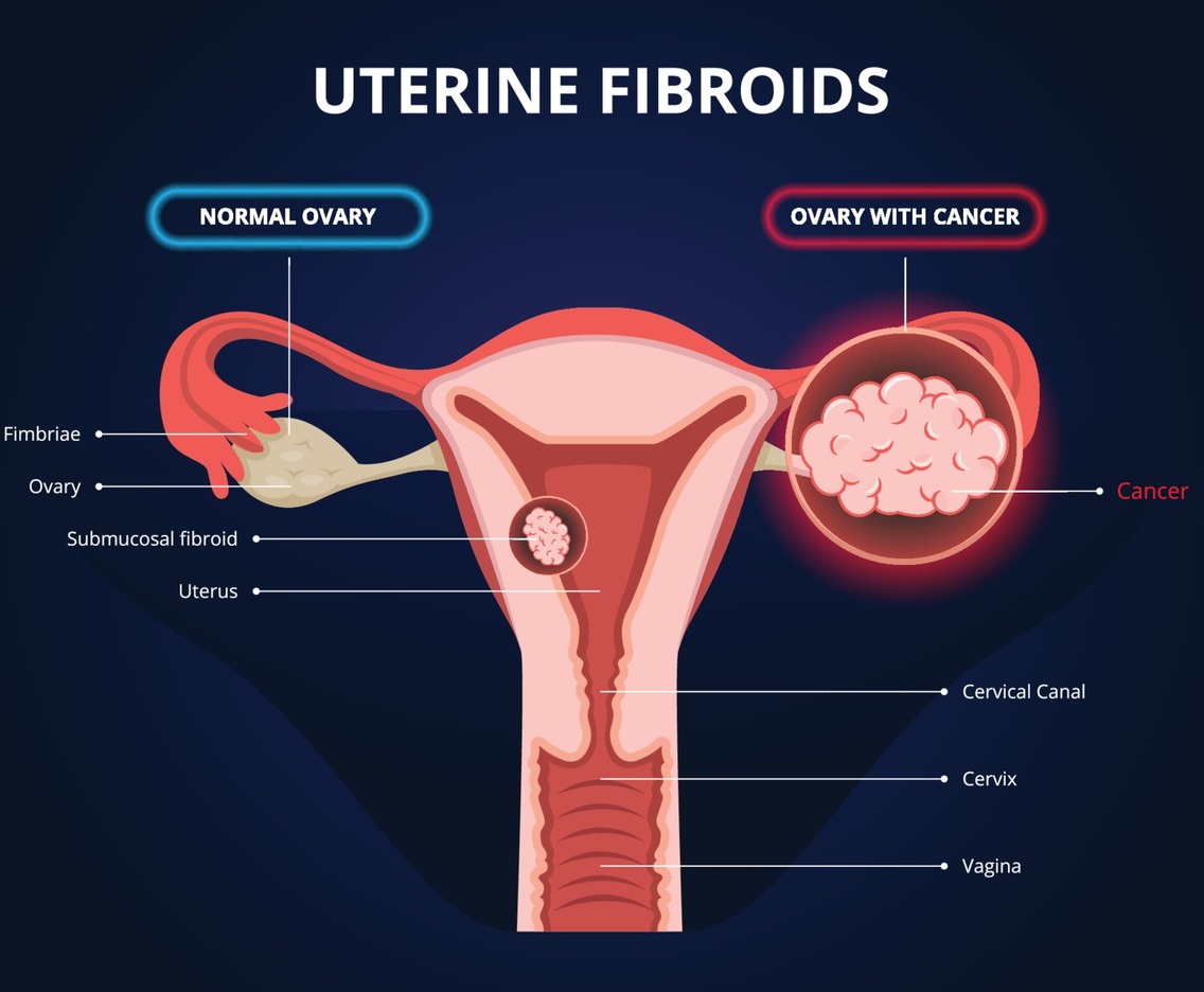Ovarian Cancer Infographics or Uterine Fibroids
